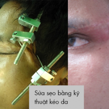 Sửa sẹo bằng kỹ thuật kéo da
