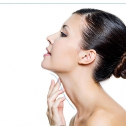 Hút mỡ dưới vùng hàm