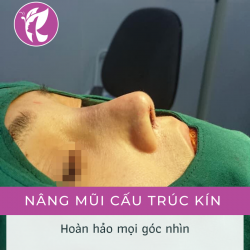 Nâng mũi cấu trúc kín (Phẫu thuật nâng mũi bằng vật liệu độn nhân tạo kết hợp sụn tự thân)
