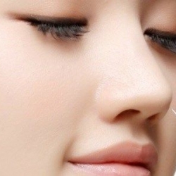Phẫu thuật chỉnh sửa biến chứng chích chất làm đầy vùng mũi