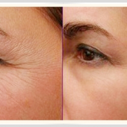 Tiêm botox điều trị nếp nhăn
